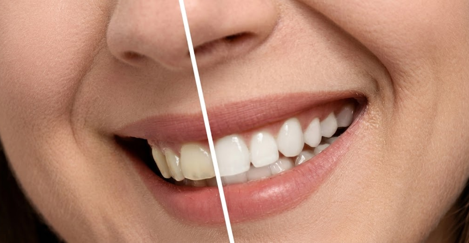 Teeth Whitening Before and After Results1